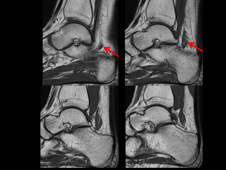 Figure 3 for case accessory flexor muscle
